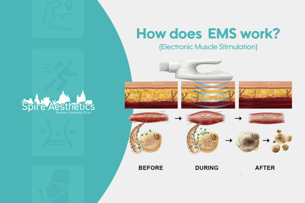 EMS treatment for post pregnancy weight loss treatment Borehamwood