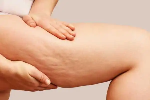 Image of woman showing leg with cellulite Borehamwood