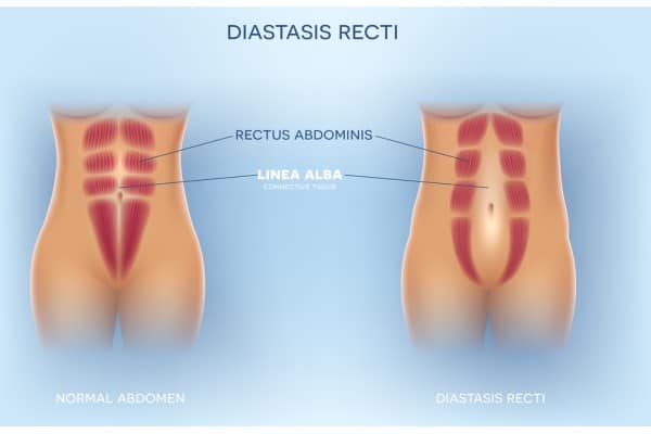 How Does Non-Surgical Treatment Help With Loose Skin, Weak Abdominal Muscles and Post-Pregnancy Changes Borehamwood?