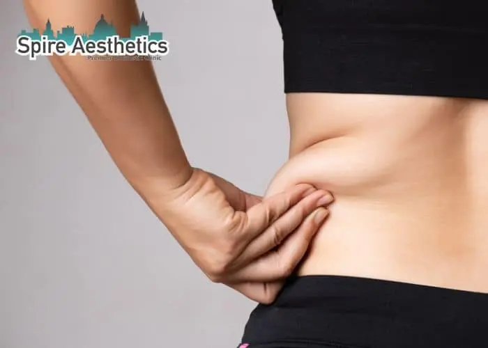 Image of woman pinching fat on their hips Borehamwood. Fat Freezing treatment 
