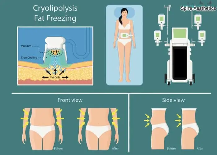 Fat freezing treatment Borehamwood benefits for competitions to remove stubborn fat deposits.