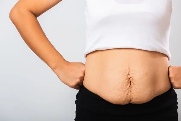 Image of a woman's stomach after weight loss with sagging skin following a gastric band Borehamwood