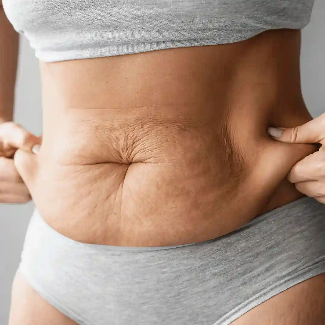 Is It Normal to Have Loose Skin After Pregnancy Borehamwood?