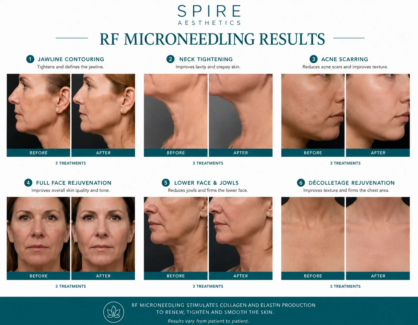 RF Microneedling Skin tightening Borehamwood results