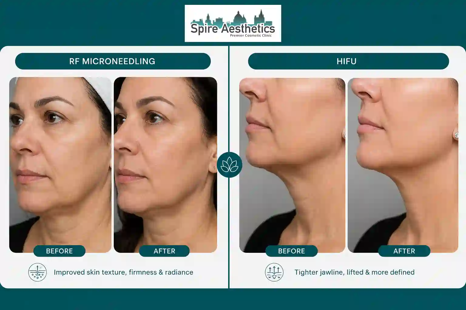 Can RF Microneedling and HIFU Be Combined Borehamwood?