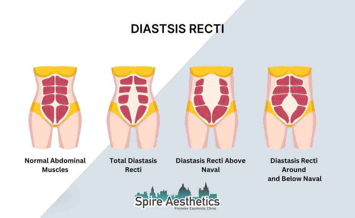 Is Non-Surgical Diastasis Recti Treatment Right for You? Common Concerns Answered Borehamwood